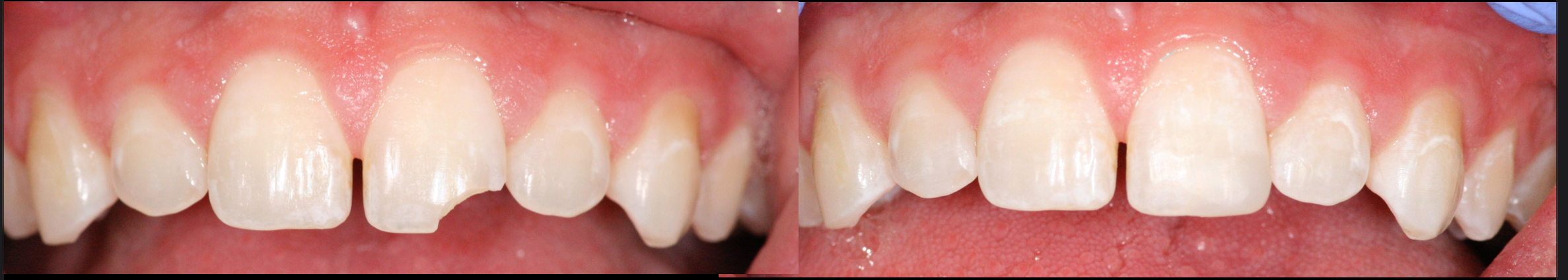 Chipped tooth repair
